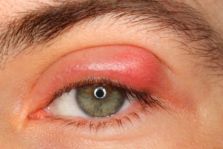 Eye Inflammation and Conjunctivitis